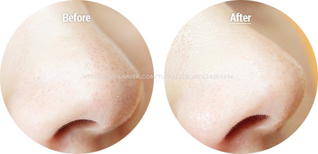 cosrx_blackheadandporezeropatch_beforeafter