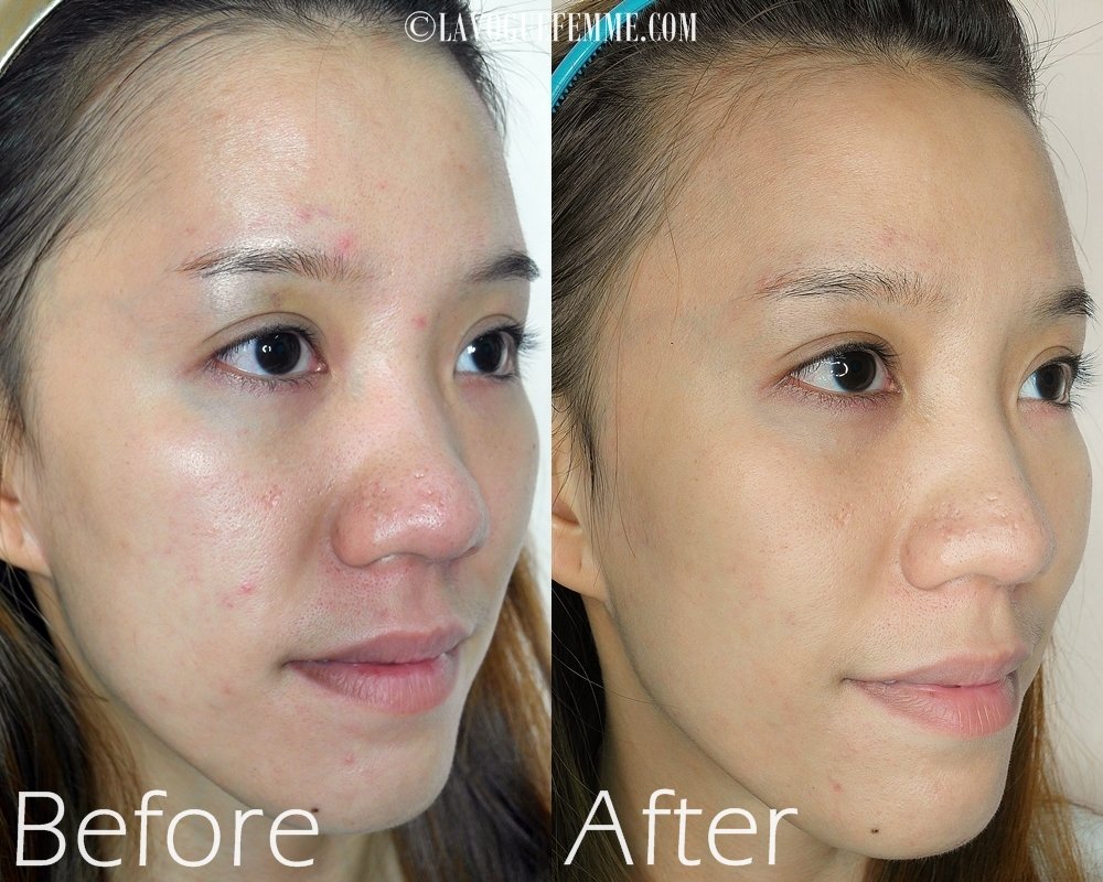 Customized-La-Belle-Ampoules-For-Combination-Acne-Prone-Skin-Before-After-Side